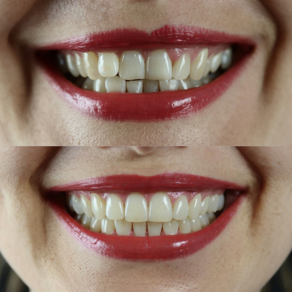 Perfect Teeth - Free AI Photo Editing Tool